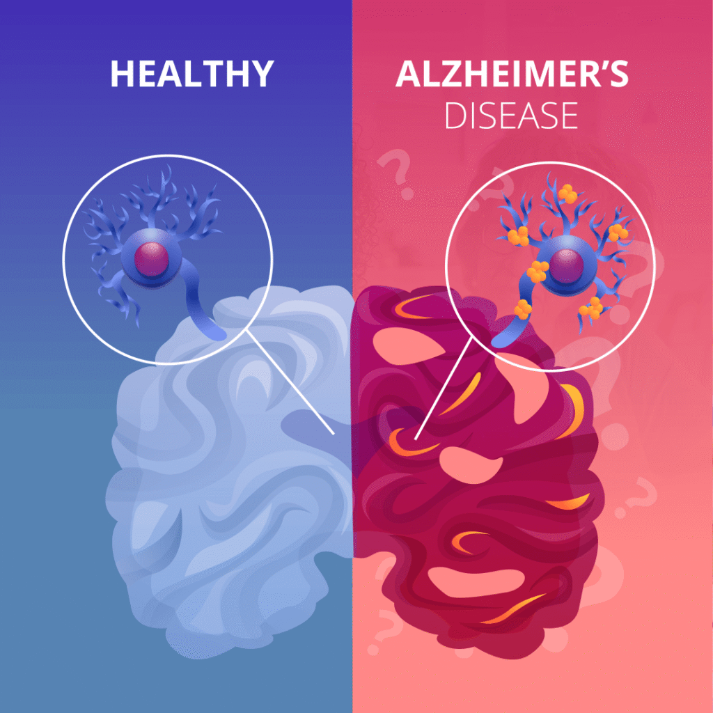 🧠 Alzheimer’s Prevention: Foods, Habits, and Early Warning Signs 2 image 10